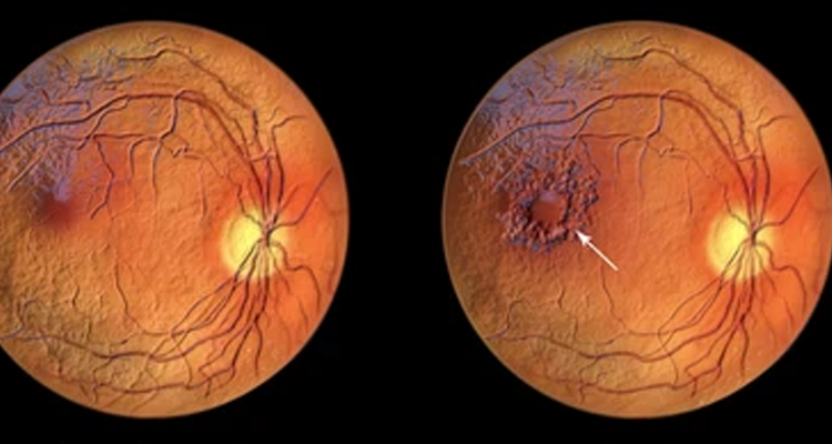 Diabetic Macular Edema