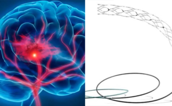 AIIMS ने किया भारत का पहला स्वदेशी स्ट्रोक डिवाइस ‘सुपरनोवा स्टेंट’ (‘Supernova Stent’) का सफल ट्रायल