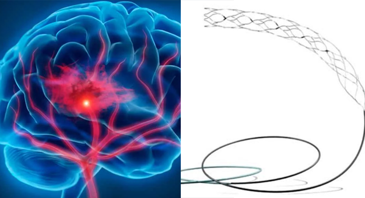 AIIMS ने किया भारत का पहला स्वदेशी स्ट्रोक डिवाइस ‘सुपरनोवा स्टेंट’ (‘Supernova Stent’) का सफल ट्रायल