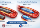 Stent-Free (स्टेंट-फ्री) Heart ट्रीटमेंट: क्या है ड्रग-एल्यूटिंग बैलून (Drug-Eluting Balloon) एंजियोप्लास्टी?