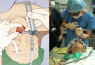 BGH Introduces Advanced Lifesaving Device to Remove Objects Stuck in Throat