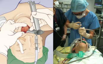 BGH Introduces Advanced Lifesaving Device to Remove Objects Stuck in Throat