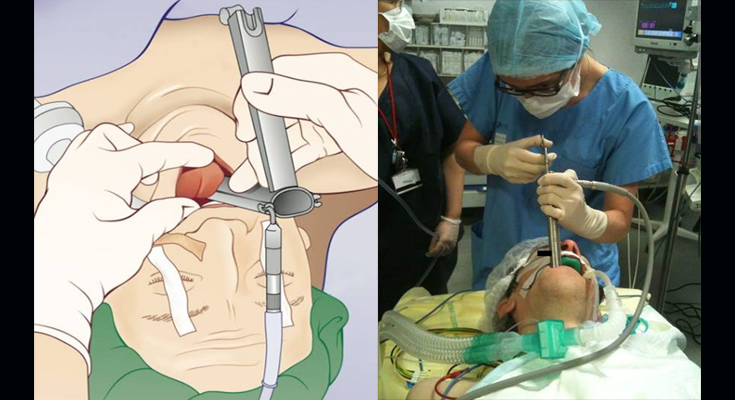 BGH Introduces Advanced Lifesaving Device to Remove Objects Stuck in Throat