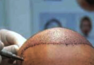 Pakistani LeT Terrorist Arrested After Hair Transplant Twist in Kashmir