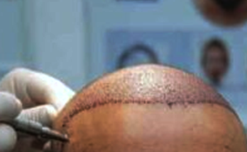 Pakistani LeT Terrorist Arrested After Hair Transplant Twist in Kashmir
