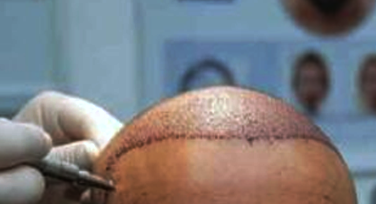 Pakistani LeT Terrorist Arrested After Hair Transplant Twist in Kashmir